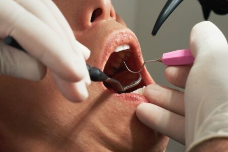 Il ruolo cruciale dell’igienista dentale nella cura della parodontite.