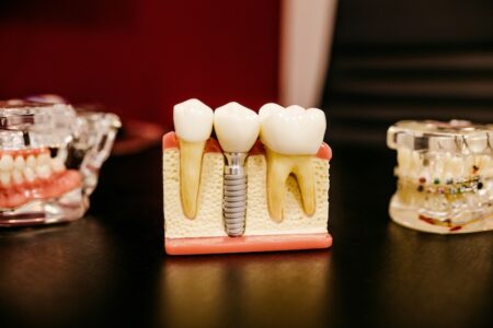 Denti mancanti? Ecco i 5 motivi principali per affidarsi all’implantologia.