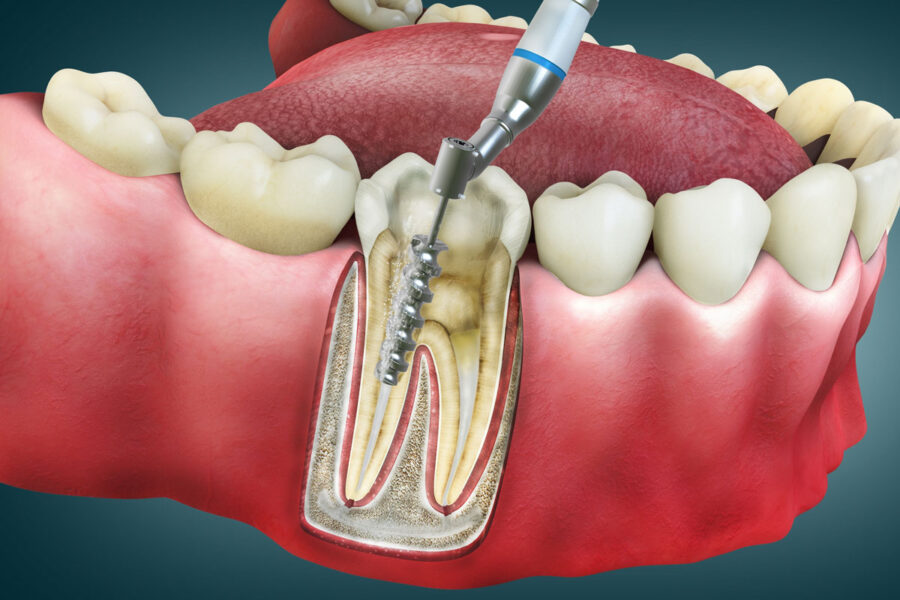 Endodonzia