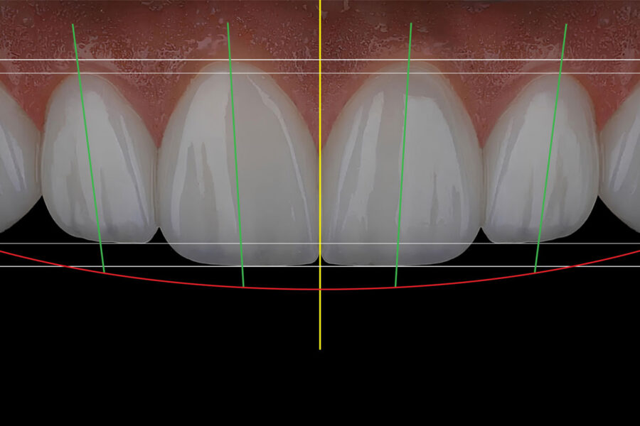 Progettazione digitale del sorriso